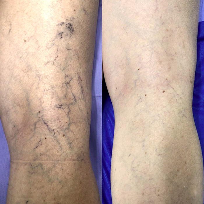 Antes y despues eliminación de várices