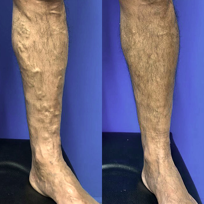 Antes y despues eliminación de várices